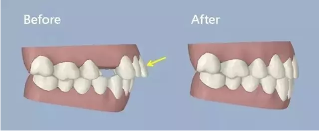 龅牙内收前牙