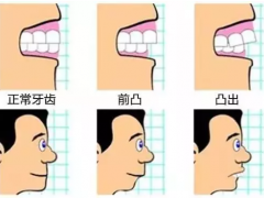 轻微骨性龅牙可以用牙套矫正吗