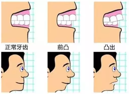 轻微骨性龅牙可以用牙套矫正吗