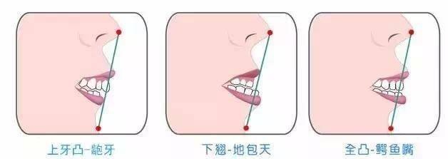 门牙龅牙矫正多少钱