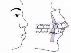 骨性龅牙矫正
