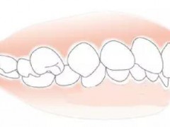 骨性龅牙怎么判断