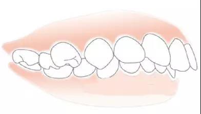骨性龅牙怎么判断