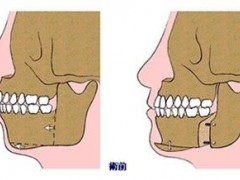 骨性龅牙怎么矫正
