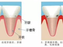 龅牙矫正多少钱