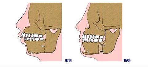 牙齿外突矫正