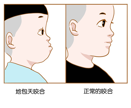 地包天矫正牙齿要多少钱