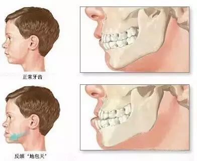 孩子矫正地包天