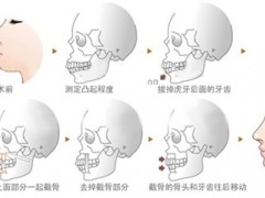 牙齿骨性前突到底要不要做正颌手术