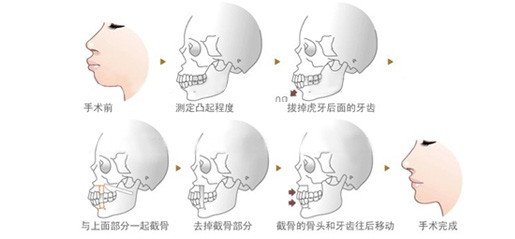 正颌手术大致过程