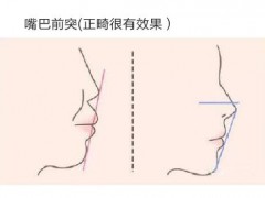 嘴凸正畸整形的大概费用是多少