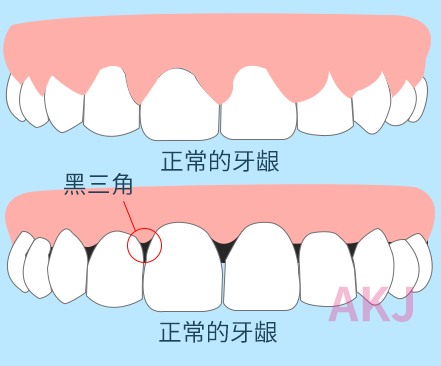 牙齿黑三角