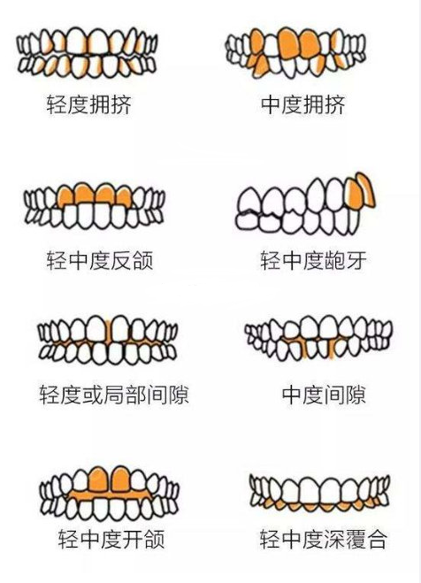 牙齿不齐的程度