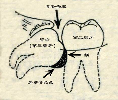 智齿的危害