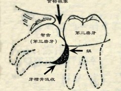 智齿长歪了能不能矫正好不拔除?听听正畸医生怎么说