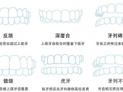 有牙科会接受戴钢牙的中途去戴隐形牙套吗