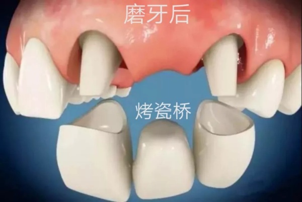 烤瓷牙固定桥