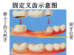 烤瓷牙基牙腐烂到什么程度不能再做烤瓷牙