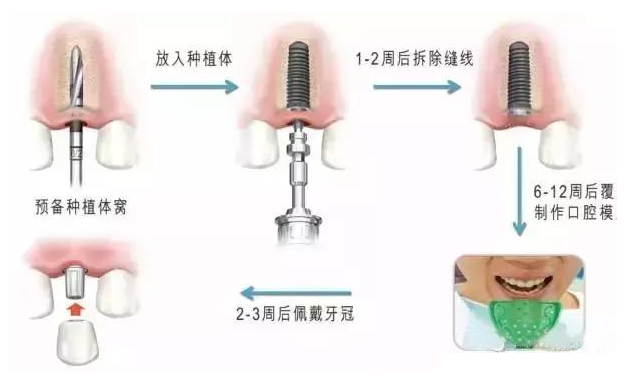 种植牙大致过程