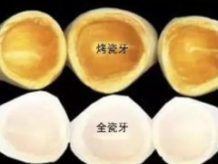 全瓷牙和纯钛牙冠哪个结实