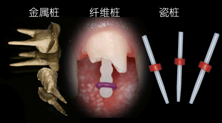 不同的桩核区别