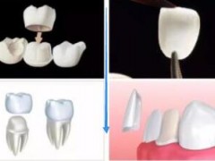 牙齿全冠修复的优缺点