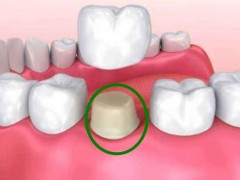 做牙冠一般要磨几颗牙
