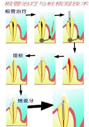 根管治疗与桩核冠修复