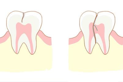 牙齿隐裂