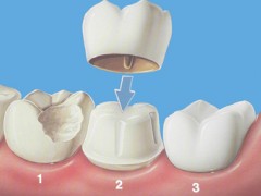 套牙冠牙齿要磨多小 戴牙冠磨牙图