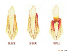 牙齿掉落，牙周病是“罪魁祸首”