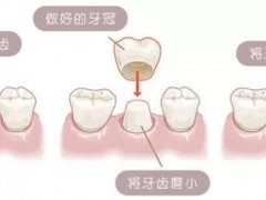 牙齿残缺修复多少钱