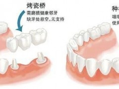 烤瓷牙固定桥修复到底好不好，价格是多少