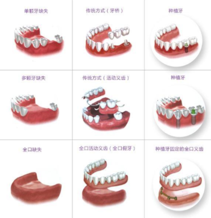 假牙在单颗牙多颗牙以及全口牙缺失后的修复