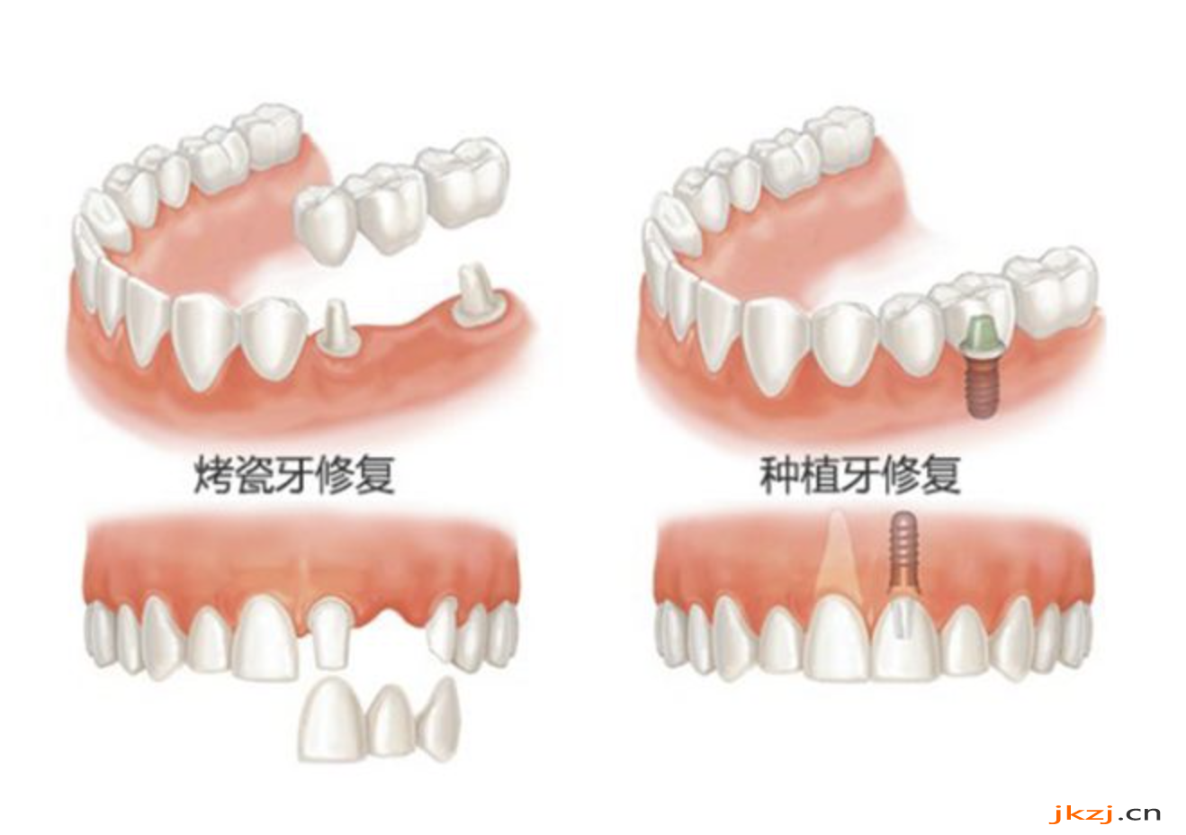 缺一颗牙做假牙