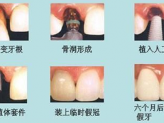 种植牙有几个步骤