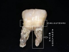 牙齿掉的快是什么原因