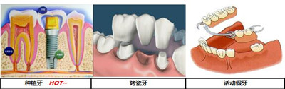 镶牙可以保多久