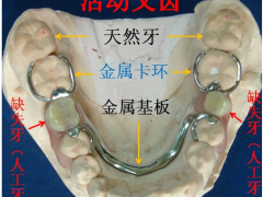 镶活动牙价格