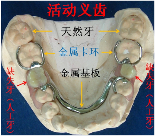 镶活动牙价格