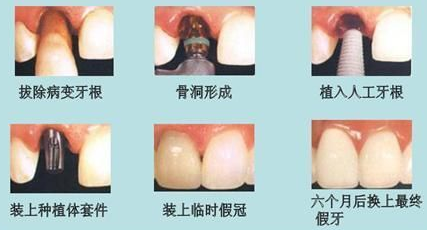 种植牙的利与弊