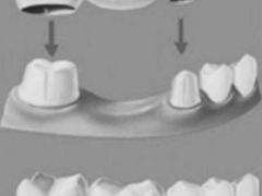 烤瓷牙、种植牙的利与弊