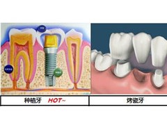 老人镶牙满口多少钱