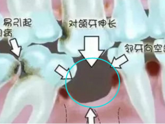 装牙齿多少钱