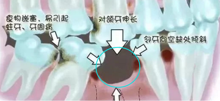 装牙齿多少钱