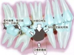 牙齿缺损、缺失及时镶牙的原因