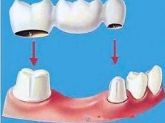 桩冠和镶牙有何区别