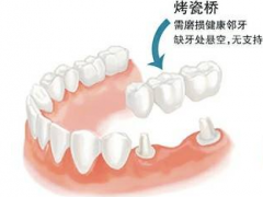 拔牙后镶牙还是种牙