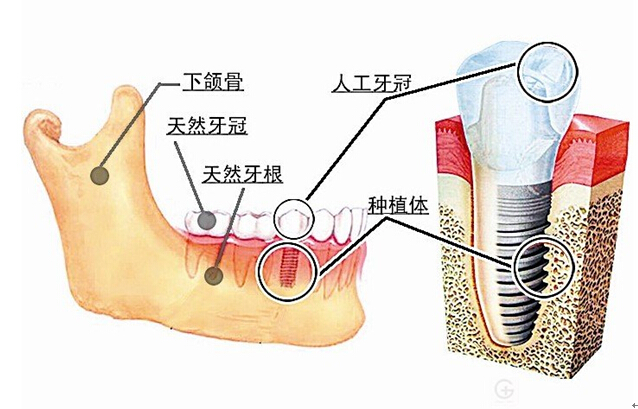 镶牙和种牙的区别