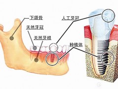 镶牙和种牙到底有什么区别